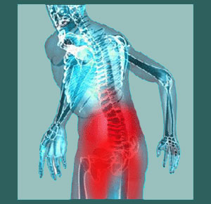 Ankylosed sacroiliac