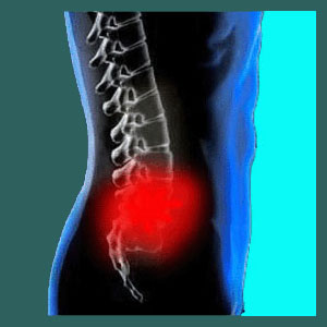 Heat or Ice for Sacroiliac