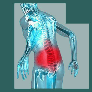 Misdiagnosed Sacroiliac Pain