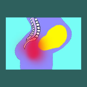 Pregnancy Sacroiliac Pain