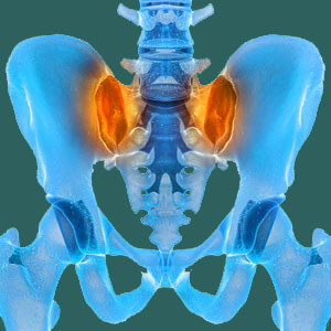 Sacroiliac arthritis