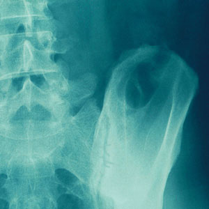 Sacroiliac Fracture