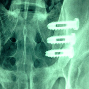 Sacroiliac fusion surgery