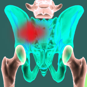 Sacroiliac injury