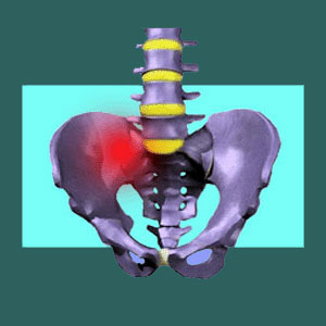 Sacroiliac Pain FAQ