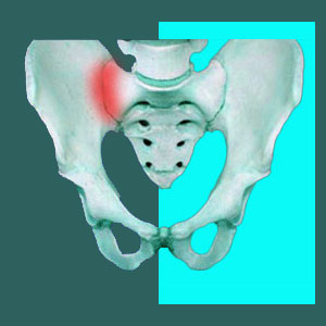 Sacroiliac Pain in Athletes