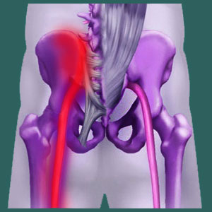 Sacroiliac sciatica