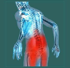 Sacroiliac Spondylitis