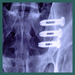 Sacroiliac Surgery