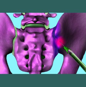 Sacroiliac Treatment