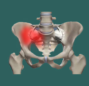 Unilateral Sacroiliac Pain